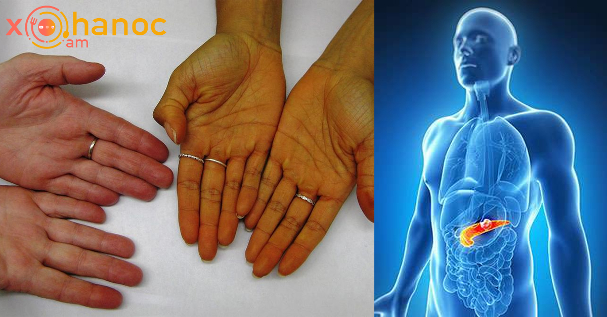 Քաղցկեղի առաջին նշանը, որը կարող ենք հասկանալ ձեռքի ափից