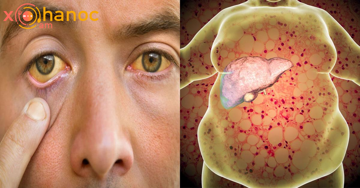 Ուշադրություն․ Սա լյարդի ճարպակալման նշան է, երբեք աչքաթող չանեք և շտապ դիմեք բժշկի