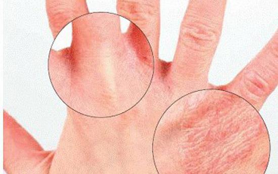 Ի՞նչ է էկզեման. առաջացման պատճառներ, ախտանիշներ և բուժում