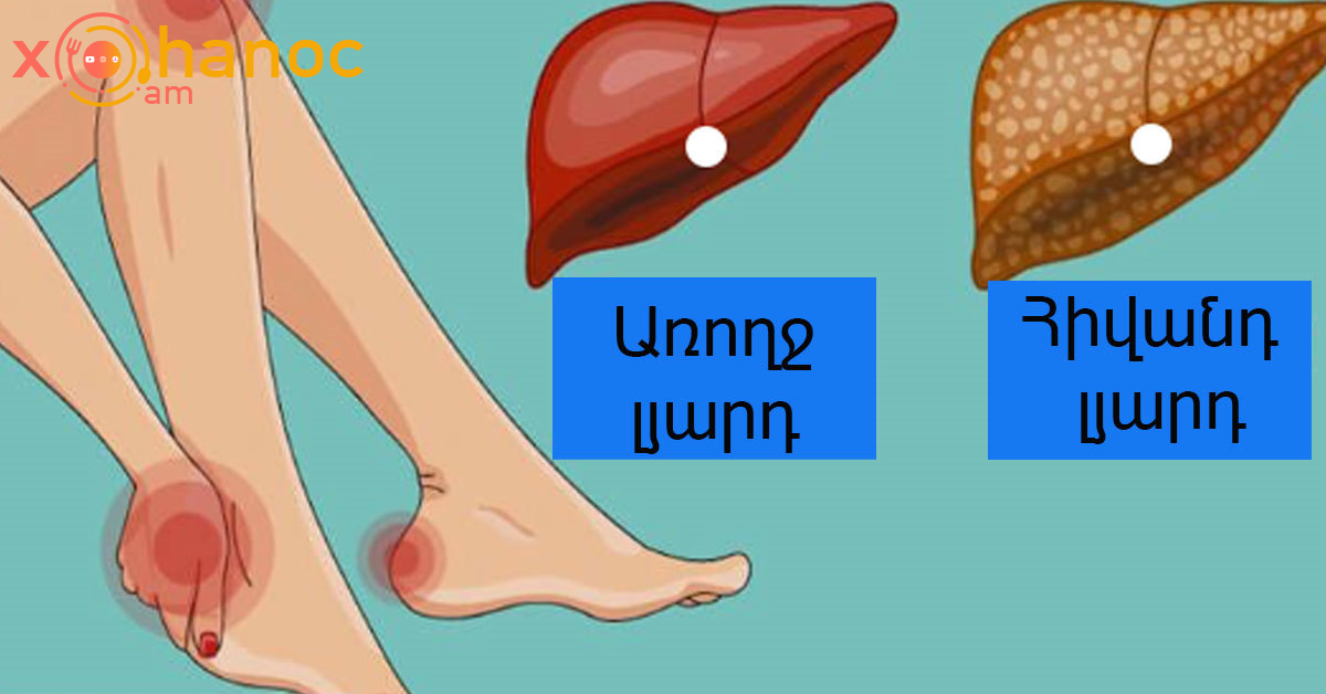 Լյարդի հիվանդության գաղտնի նշան, որը ոչ մի դեպքում մի անտեսեք