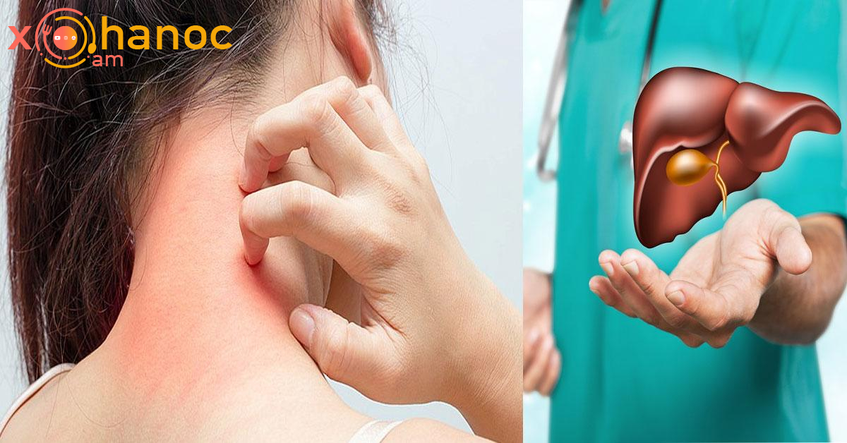 Բժիշկը նշել է հիվանդ լյարդի առաջին նշանները․ Այն կարելի է տեսնել անզեն աչքով