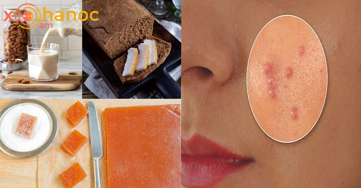 Այս մթերքները դեմքի վրա պզուկներ են առաջացնում․ Ուտելուց առաջ իմացեք այս մասին