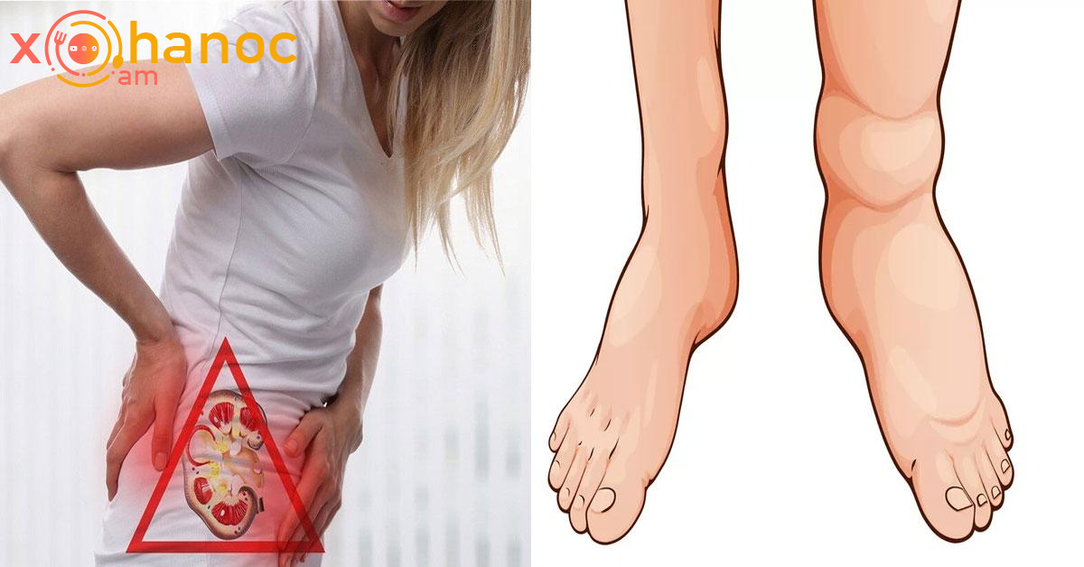 Ուշադրություն․ Նախազգուշացնող նշան, որ ձեր երիկամները հիվանդ են, պետք է շտապ այցելեք բժշկի