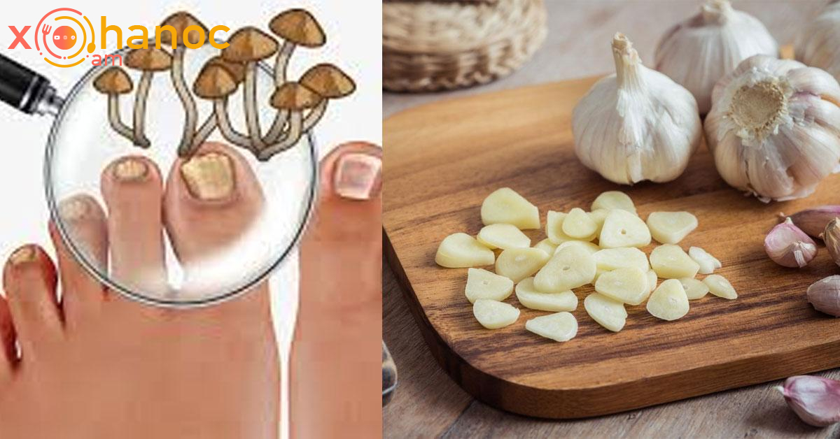 Սխտորի միջոցով ազատվեք եղունգների սնկից