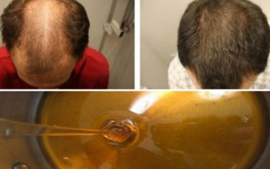 Վերականգնեք մազերի աճը