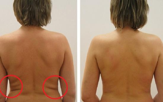 Ազատվեք ճարպակալումից, արյան բարձր ճնշումից և դեպրեսիայից