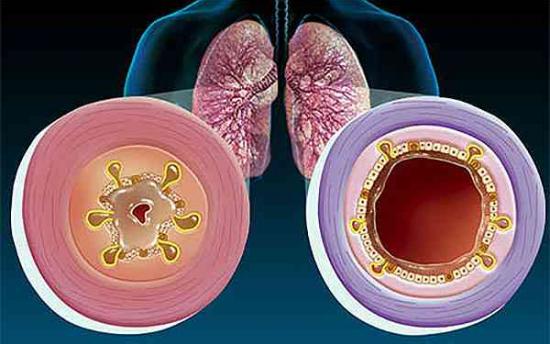 Ազատվեք ալերգիայից, բրոնխիտից, ասթմայից և այլ հիվանդություններից: 100% արդյունավետ միջոց: