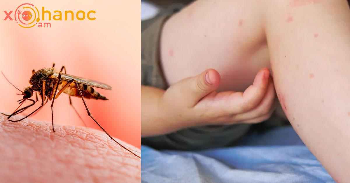  ՀՀ-ում արձանագրվել է «Չիկունգունիա տենդ» հիվանդության դեպք