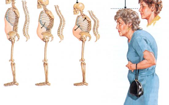 Մոռացեք օստեոպարոզի մասին