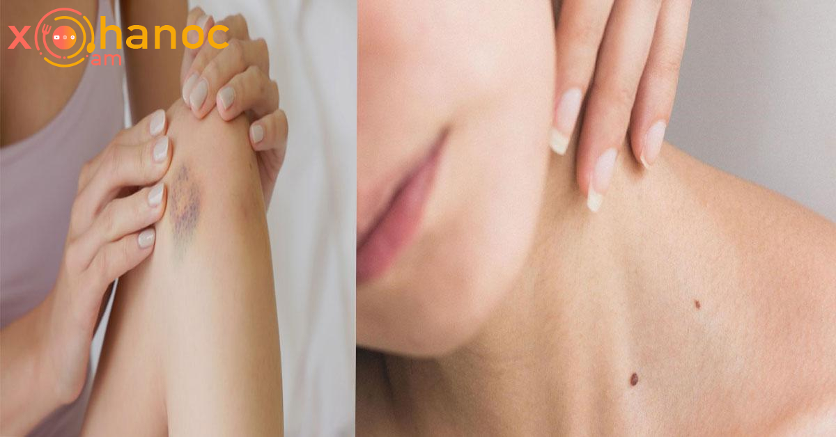 Քաղցկեղի առաջին նշանները մաշկի վրա են հայտնվում