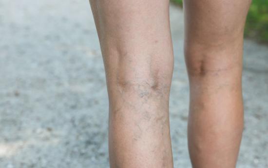 Դեն նետեք դեղամիջոցներն ու ավելորդ ծախսերը․ Այս պարզ խորհուրդը կօգնի ձեզ խուսափել երակների վարիկոզ լայնացումից