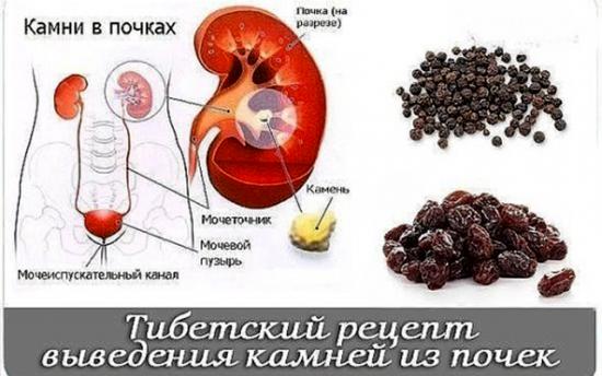 Ինչպե՞ս բուժել միզաքարային հիվանդությունները