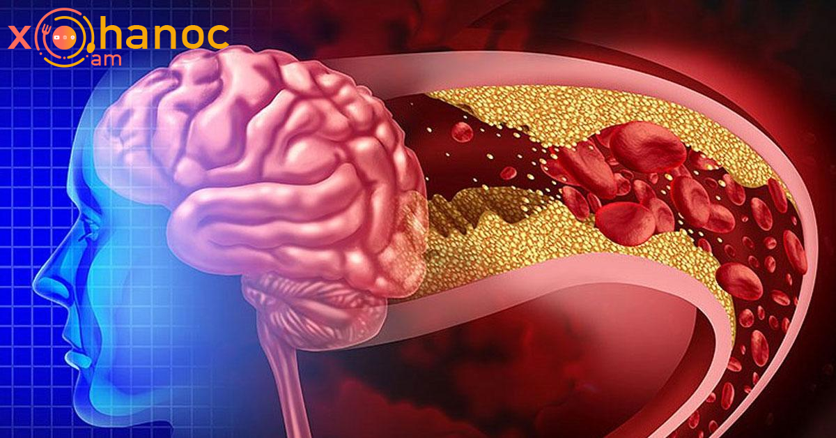 Որո՞նք են աթերոսկլերոզ ախտանիշները, ովքե՞ր են ռիսկի խմբում և ինչպե՞ս կանխարգելել հիվանդությունը