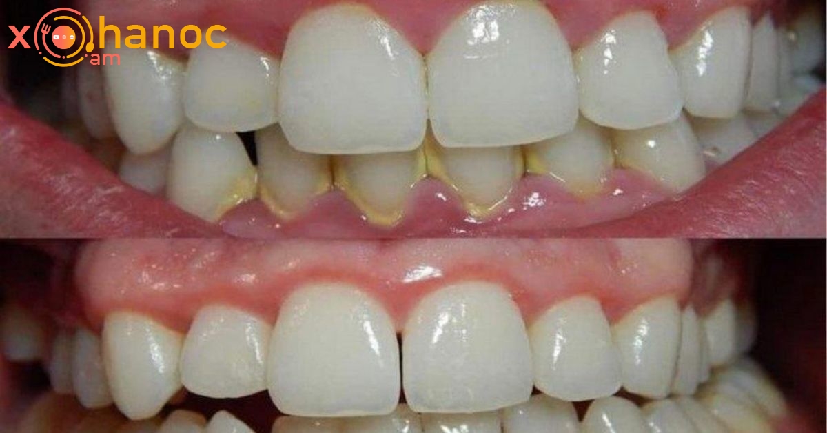 Եթե ձեր ատամները այսպես են, ապա կարող եք ատամնաքարերը հեռացնել՝ առանց ատամնաբույժի դիմելու