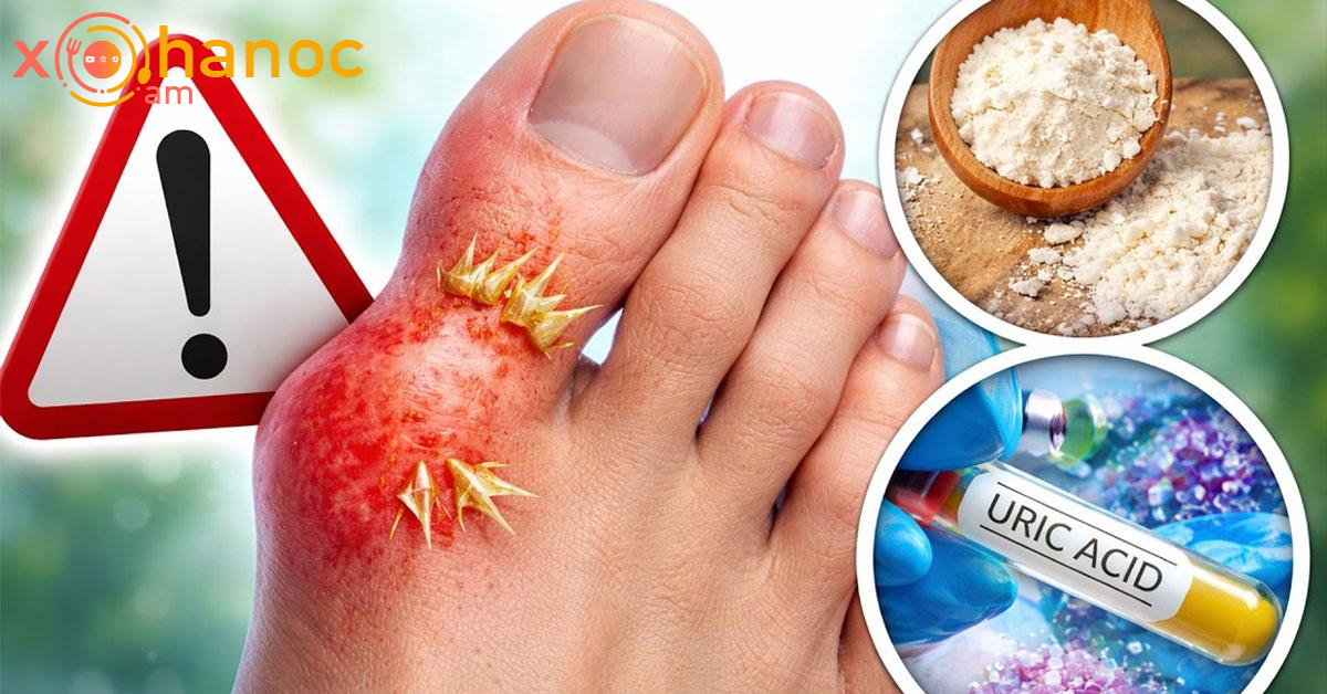 Ինչպես վերացնել ոտքի վրա աճած ոսկորը և նվազեցնել միզաթթուն