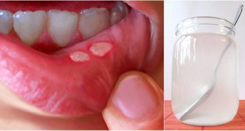 Ինչպես տնային պայմաններում բուժել ստոմատիտը. արդյունքն ապշեցնում է