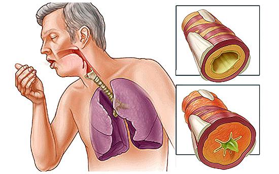 Մոռացեք հազի ու բրոնխիտի մասին. բնական հրաշք դեղամիջոց