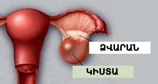 Ձվարաններում կիստայի առկայության 9 նշան, որոնք չի կարելի անտեսել