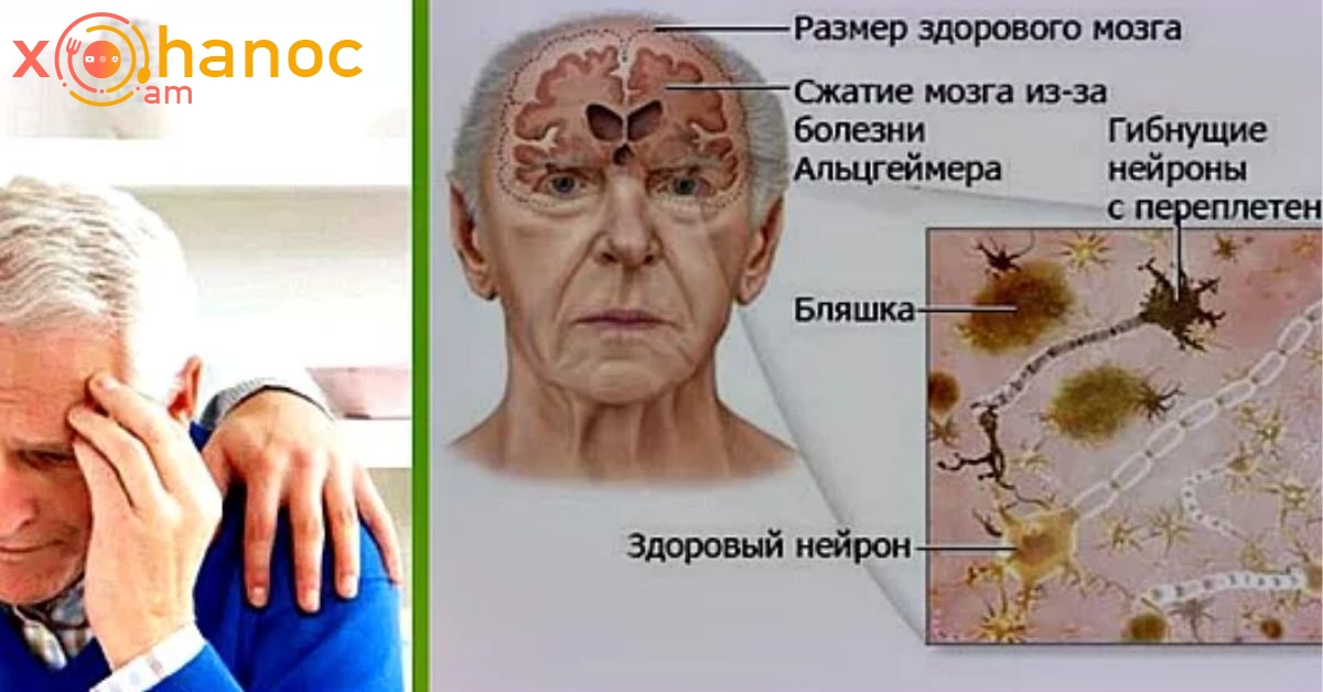 Деменция альцгеймеровского типа. Стадии болезни Альцгеймера. Слабоумие у пожилых. Синдром Альцгеймера. Люди больные Альцгеймером.