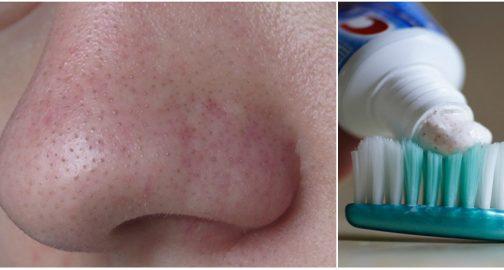 Քթի վրայի սև կետիկներից ազատվելու հրաշք միջոց 