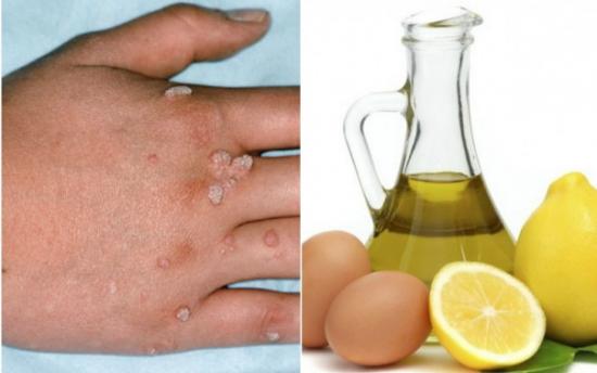 Գորտնուկներից ազատվելու ամենալավ միջոցը