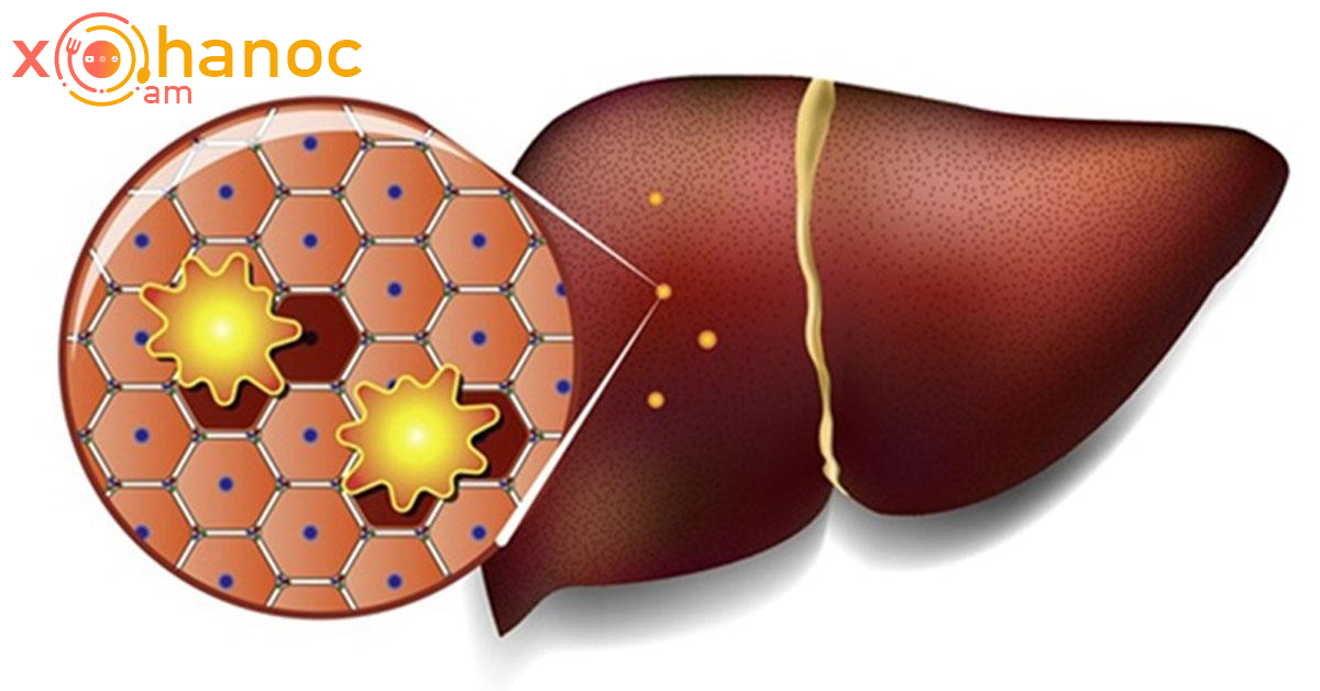 Որոնք են լյարդի ճարպակալման ախտանիշները