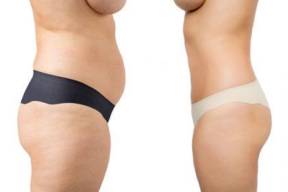 Ազատվեք ավելորդ կիլոգրամներից. մինուս 12 կիլոգրամ՝ մեկ ամսում