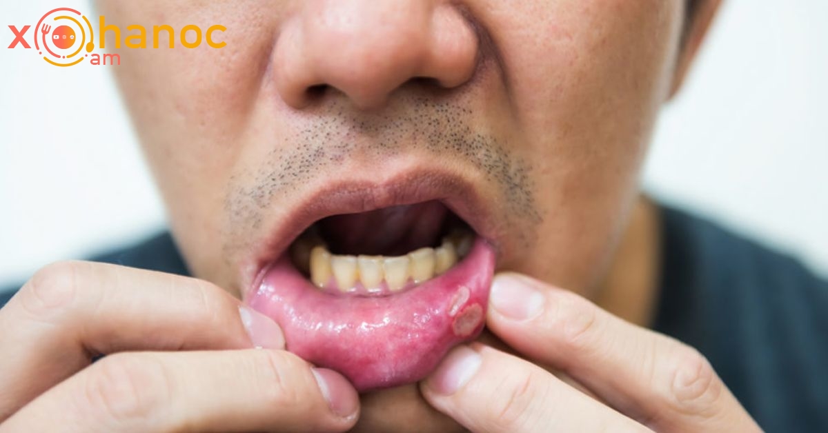Բերանի խոռոչում այս փոփոխությունները կարող են վկայել քաղցկեղի մասին