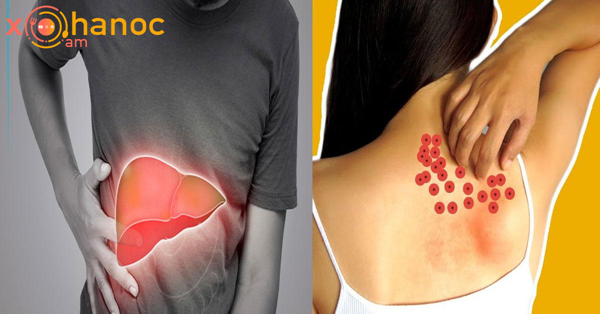 2 թաքնված նշան, որը ցույց է տալիս, որ ձեր լյարդը հիվանդ է