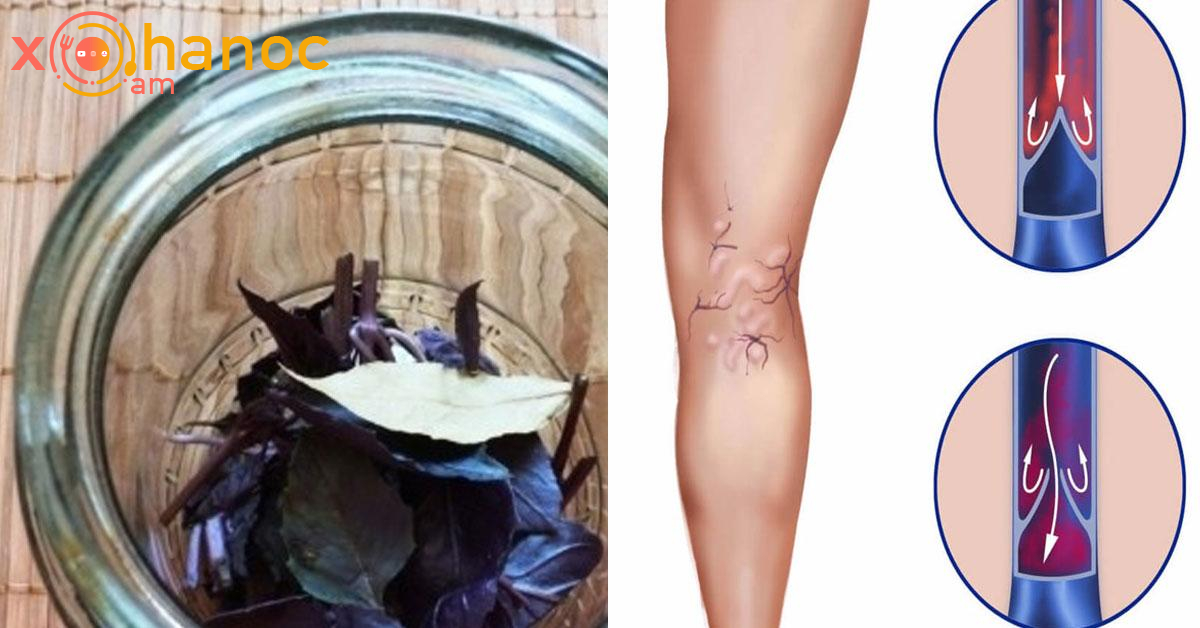 Վարիկոզի դեմ շատ օգտակար միջոց է սա