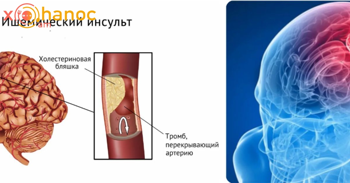 Սա ամենահզոր բաղադրատոմսն է, որը մի քանի օրվա ընթացքում կմաքրի արյունը և ուղեղի անոթները