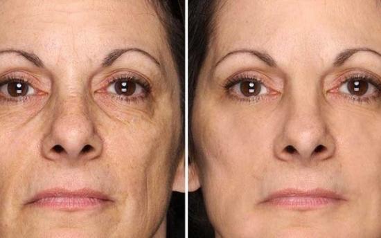 Բնական հրաշք քսուք կնճիռների դեմ