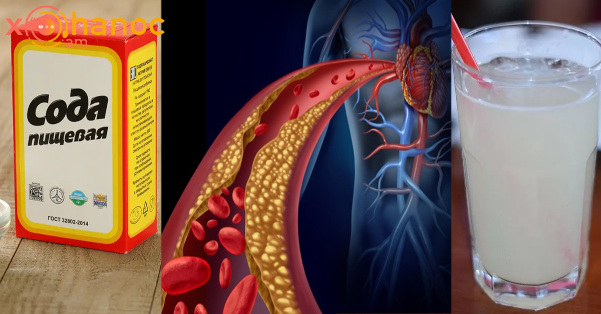 Ինչպես սոդայի միջոցով իջեցնել բարձր խոլեստերինը