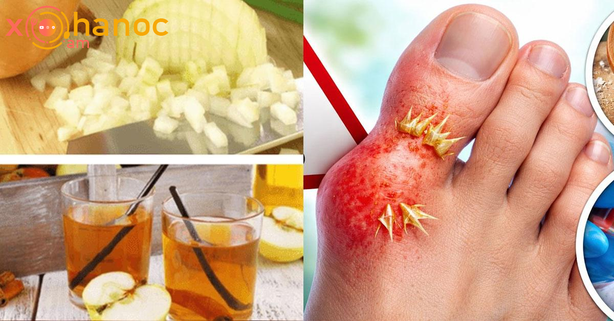 Ինչպես հեռացնել միզաթթուն հոդերից և ազատվեցի հոդատապից․ Ահա շատ արդյունավետ միջոց