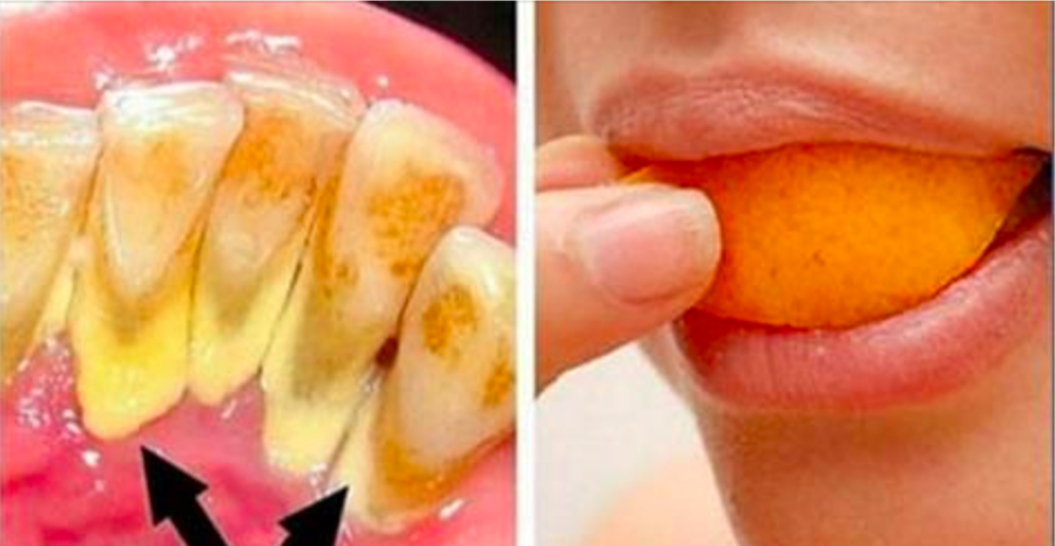 Եղեք սեփական ատամնաբույժը. ահա հնարքներ, որոնք տնային պայմաններում կվերացնեն ատամնաքարի կուտակումը