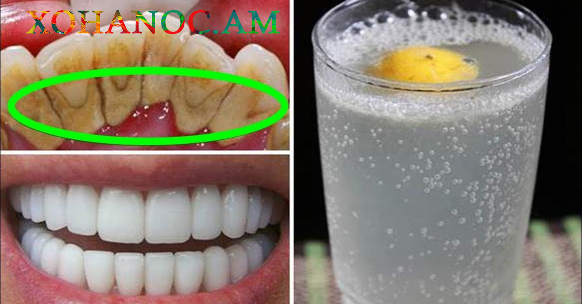 Ինչպես արագ սպիտակեցնել ատամները