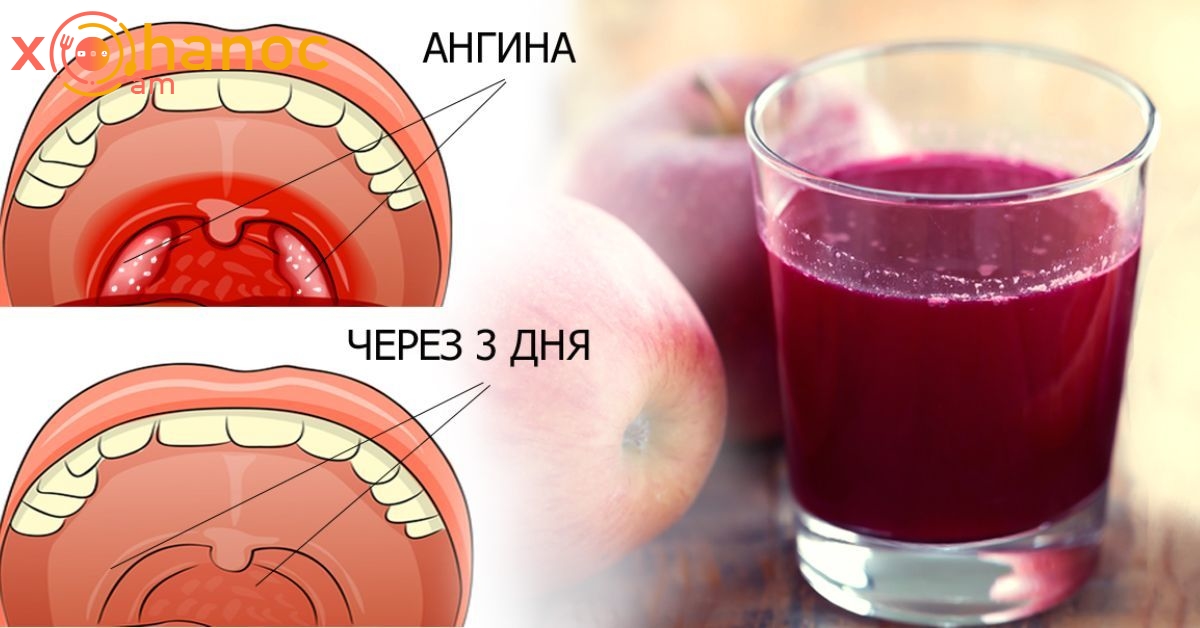 Խնդրում ենք կարդալ սա նախքան այս տեղեկատվությունը կջնջվի. Կոկորդի վարակի բուժումը ձեր ձեռքերում է