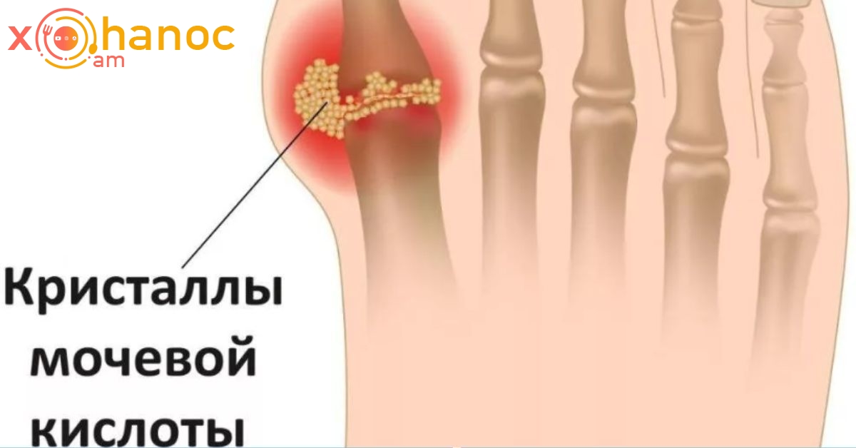 Հեռացրեք միզաթթուն ձեր օրգանիզմից, որի շնորհիվ կվերանան հոդացավերն ու հոդատապը