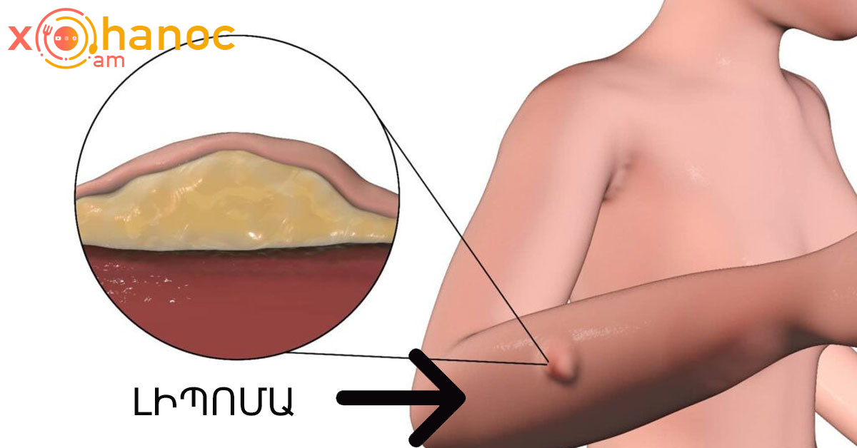 Ինչպե՞ս ազատվել ճարպային հյուսվածքից (լիպոմա)