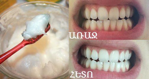 Հզոր բնական միջոց՝ ատամների բնական փայլն ու սպիտակությունը վերականգնելու համար 