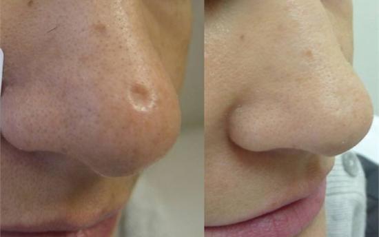 Ազատվեք դեմքի սպիներից բնական բաղադրիչների միջոցով