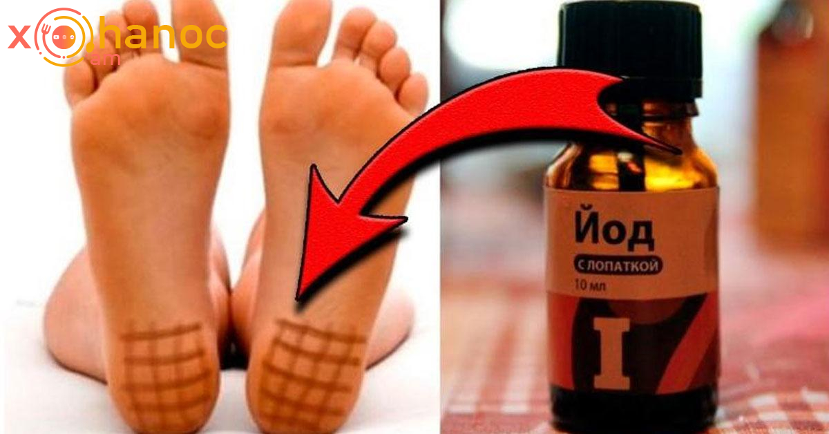 Տեսեք ինչ հիվանդությունից կազատվեք, եթե յոդով այսպիսի ցանց անեք Տեսեք ինչ հիվանդությունից կազատվեք, եթե յոդով այսպիսի ցանց անեք