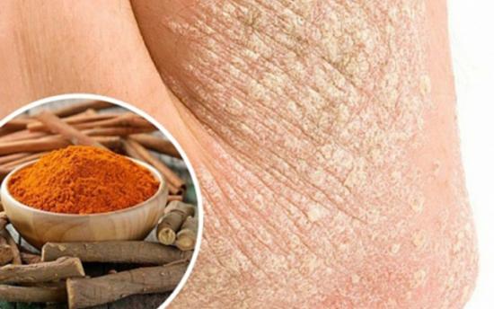 Ինչպես պայքարել պսորիազի դեմ բնական միջոցներով. 7 խորհուրդ