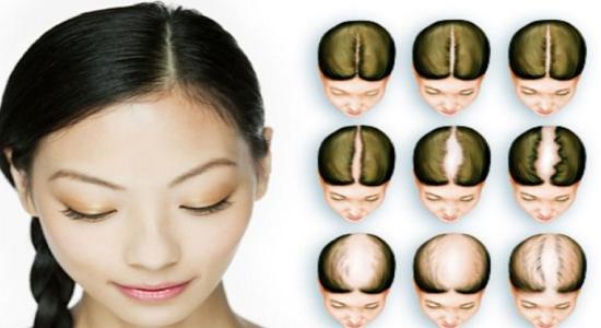 Ճաղատացման դեմ նոր դեղամիջոց: Ասում են այն իսկապես 100 տոկոսով արդյունավետ է