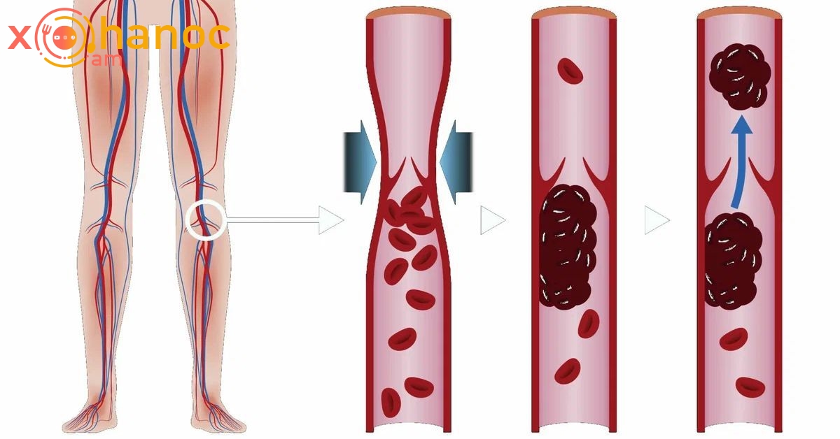 Ի՞նչ ազդանշաններ է ուղարկում մարմինը, երբ ոտքերի անոթներում արյան թրոմբ է առաջանում, ինչը շատերն անտեսում են