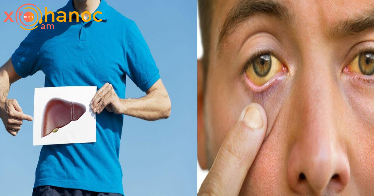 Նշաններ, որ ձեր լյարդը ճարպակալած է․ Ուշադրություն դարձրեք հատկապես 2-րդ կետին