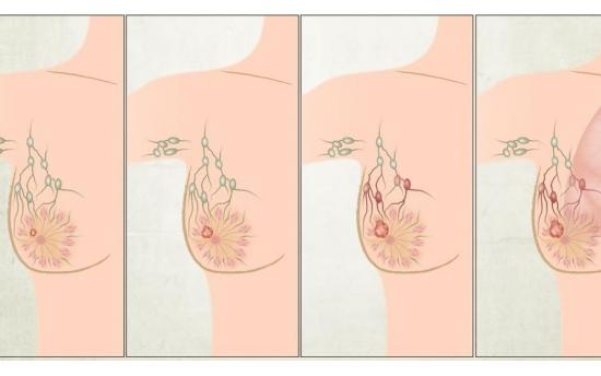 Մենք ամեն օր խմում ենք ՍԱ, բայց չգիտենք, որ այն առաջացնում է կրծքագեղձի քաղցկեղ