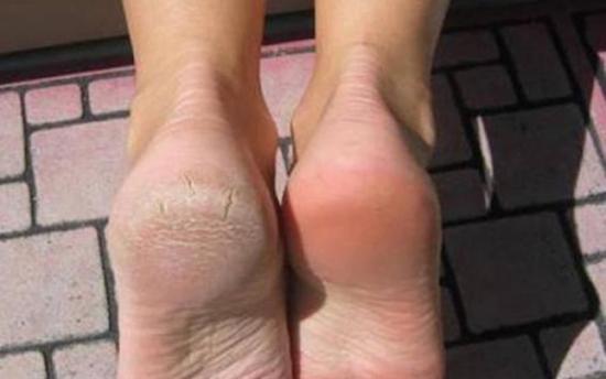 Ձեզ անհանգստացնում է կրունկների ճաքը։ Այս բաղադրիչ ձեր համար է ՝ իդեալական կրունկներ շատ կարճ ժամանակում