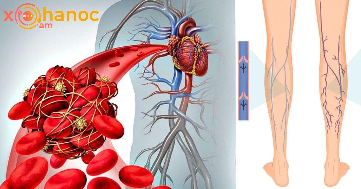 Արյան թրոմբի 4 վաղ նախանշաններ, որոնց անտեսման դեպքում վտանգավոր կլինի