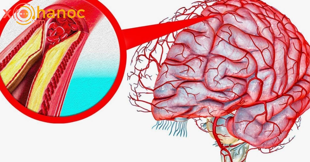 Ինչպե՞ս օգնել ուղեղի արյունատար անոթներին